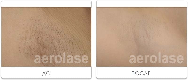 Laser Hair Removal3