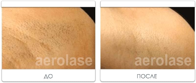 Laser Hair Removal2